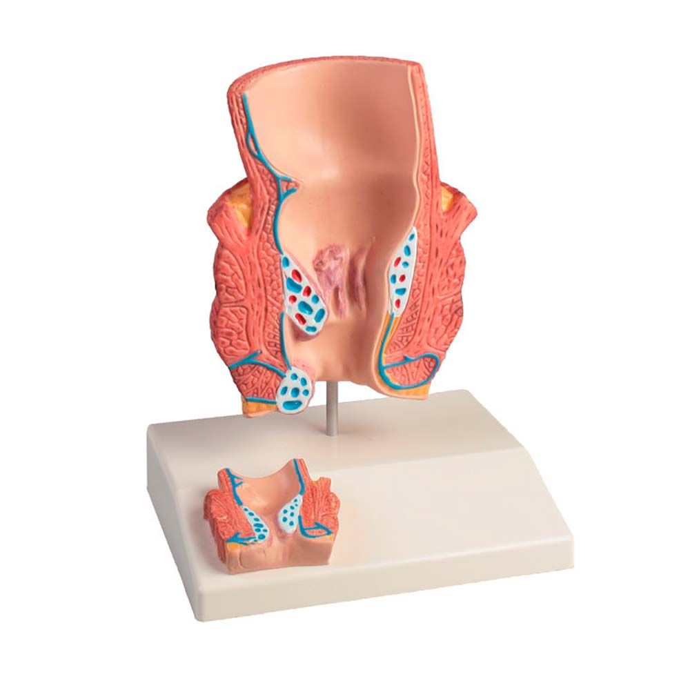 Medizinisches Tischmodell mit Hämorrhoiden-Darstellung, mehrteiliges Anatomie-Modell