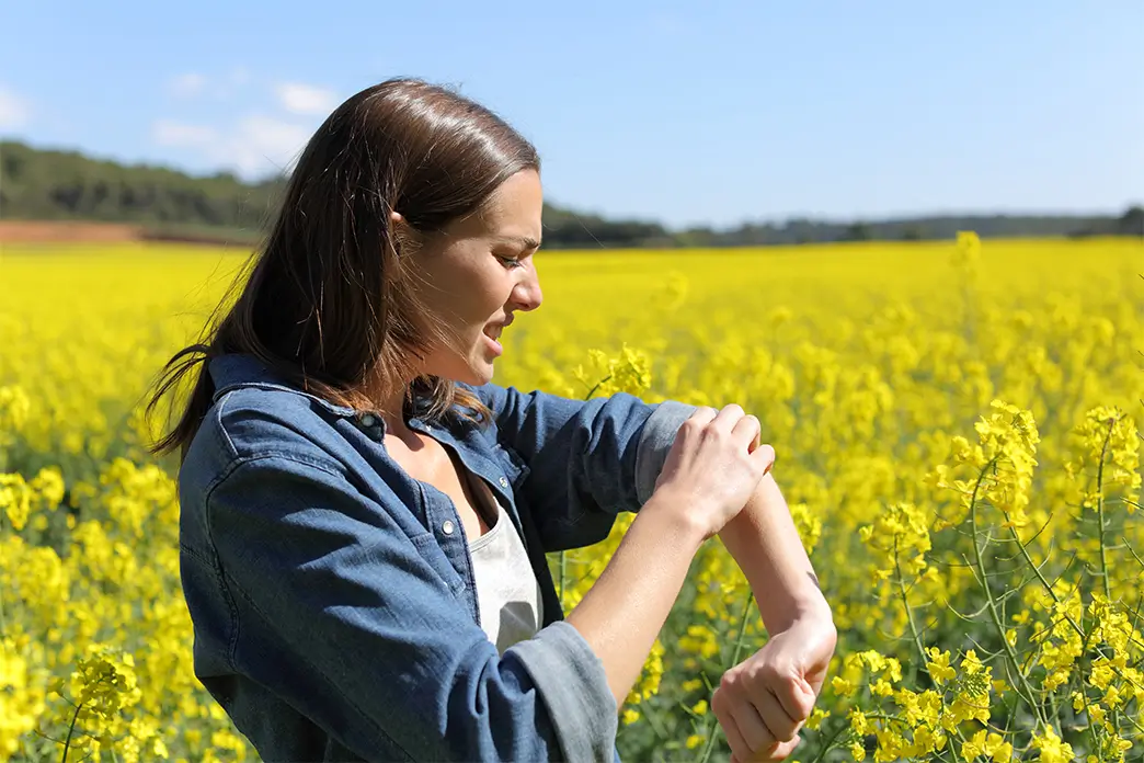 Insektenstiche lassen sich in Frühjahr und Sommer nicht immer vermeiden 